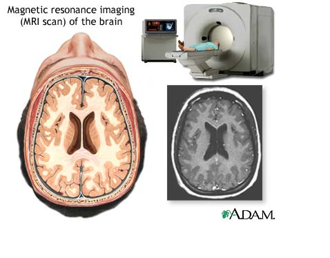 Picture of an MRI Brain Scan and an MRI Scan Machine of a male patient lying down in it.