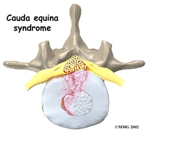 Cauda Equina Syndrome