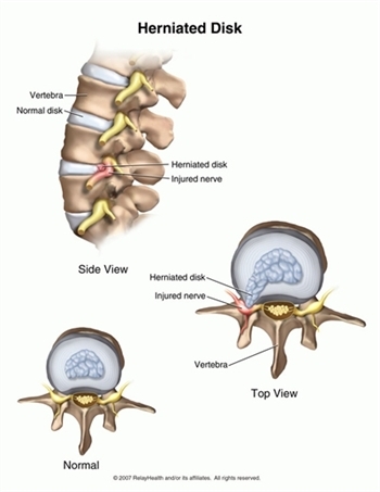 Herniated Disk Diagram